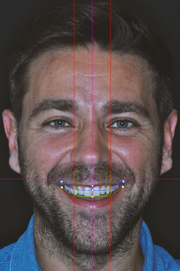 A man smiling to show how his teeth look before his dental treatment with Digital Smile Design 