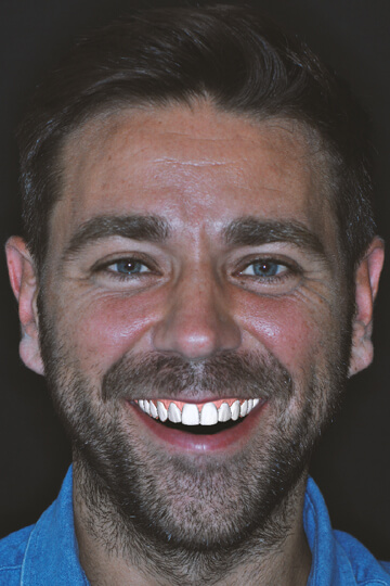 A man smiling widely with a computer simulation of his new smile design digitally placed over his own teeth