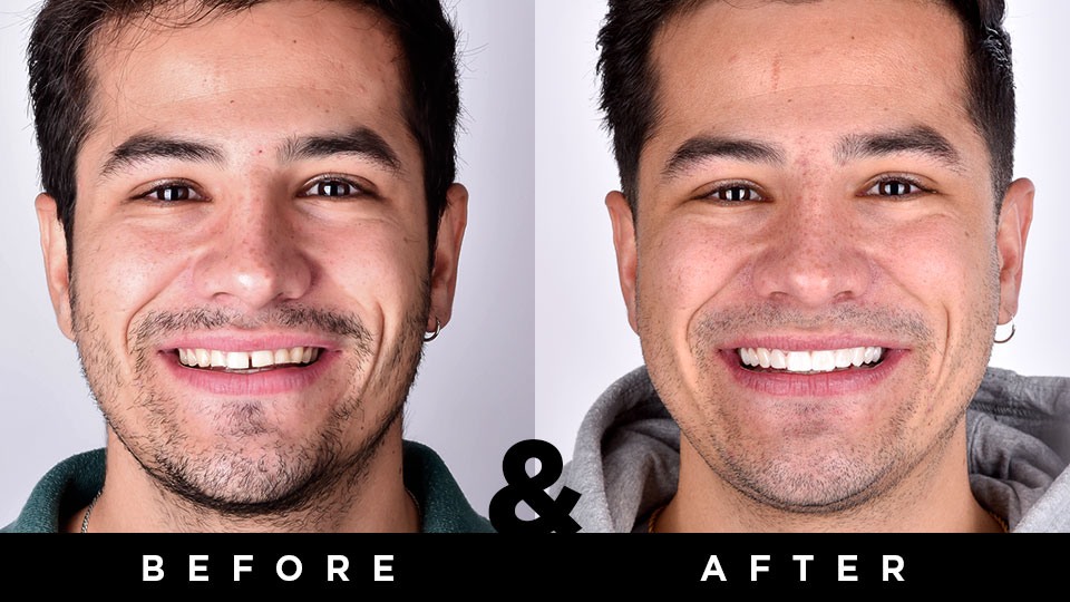 Two photos show a young man before and after he gets a new smile with Digital Smile Design
