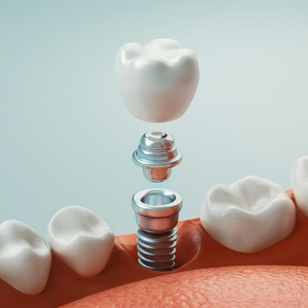 Dental_Implants_Main_Page_Natural_Restorations_2_V2