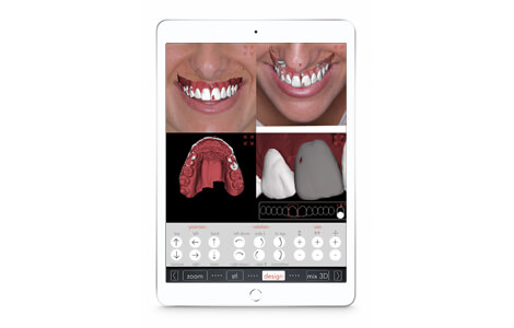The design of a patient's new smile on the Digital Smile Design app