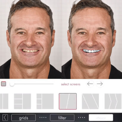  Two photos of a patient showing the difference between a natural smile and a very bright white smile
