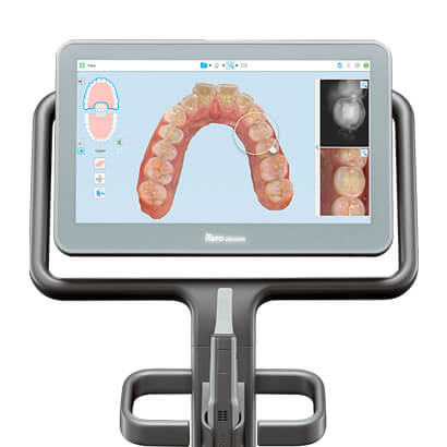 An intraoral scanner with an image of a patient’s teeth on screen