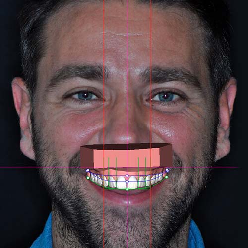 A patient smiling widely with the computer simulation of his new smile design placed digitally over the top of his own teeth