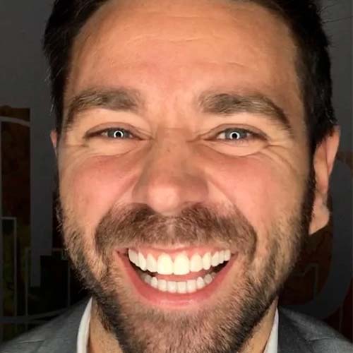 A patient is wearing the 3D-printed model of his smile design over his own teeth and smiling widely to show what it looks like